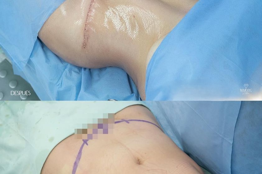 Abdominoplastia antes y después - 879983