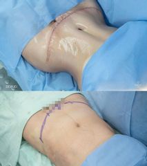 Abdominoplastia