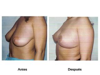 Mamoplastia de Reducción