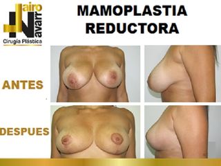 mamoplastia reductora