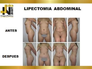 lipectomia abdominal
