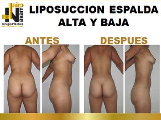 liposuccion espalda alta y baja