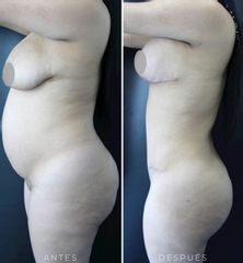 Lipoescultura - Dr. Darío Jurís