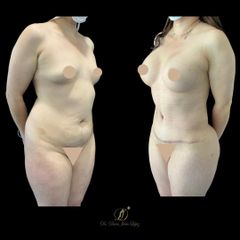 Lipoescultura - Dr. Darío Jurís