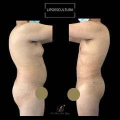 Lipoescultura - Dr. Darío Jurís