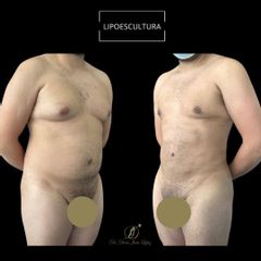 Lipoescultura - Dr. Darío Jurís