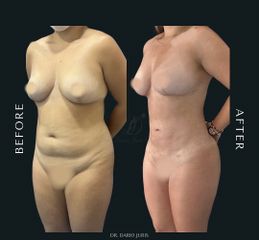 Lipoescultura - Dr. Darío Jurís