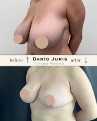 Mamoplastia de reducción - Dr. Darío Jurís