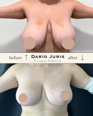 Mamoplastia de reducción - Dr. Darío Jurís
