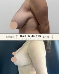 Mamoplastia de reducción - Dr. Darío Jurís