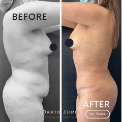 Lipoescultura - Dr. Darío Jurís