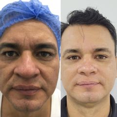 Rejuvenecimiento facial - Dra. Andrea Traslaviña