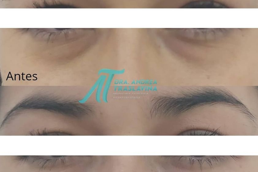 Eliminar ojeras antes y después - 863553