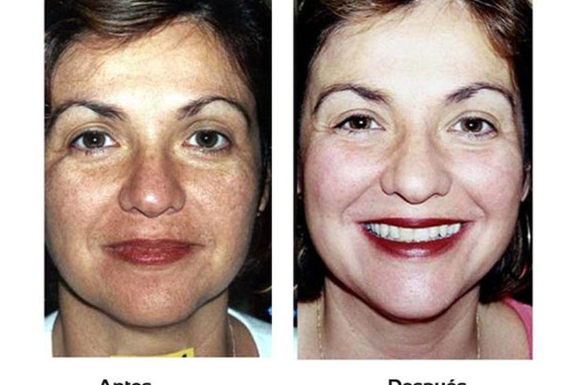 Microdermoabrasión antes y después - 511242
