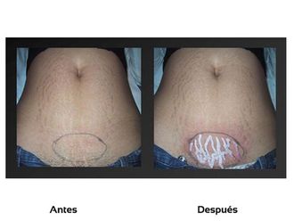 Eliminar estrías antes y después - 511243