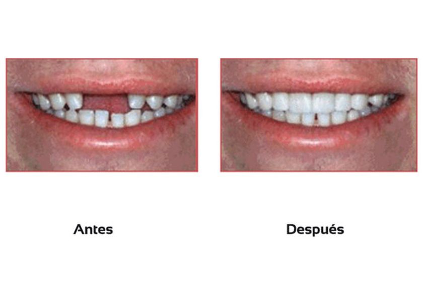Implantes dentales antes y después - 511245