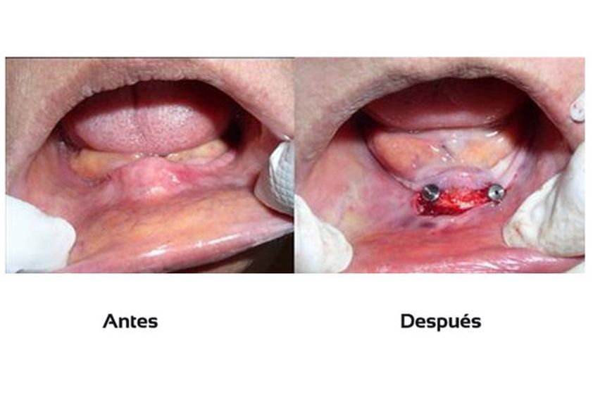 Implantes dentales antes y después - 511246