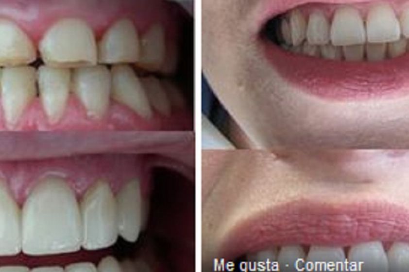 Diseño de sonrisa antes y después - 579220