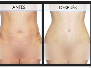 Abdominoplastia