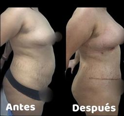Lipoabdominoplastia