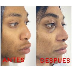 Rinoplastia - Dr. Hugo Javier Mejía Cuello