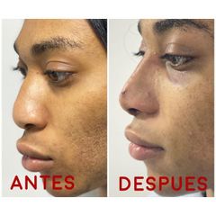 Rinoplastia - Dr. Hugo Javier Mejía Cuello