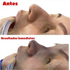 Rinoplastia - Dr. Hugo Javier Mejía Cuello