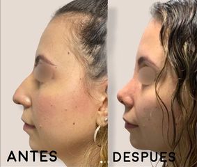 Rinoplastia - Dr. Hugo Javier Mejía Cuello