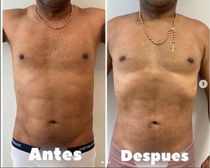 Liposucción - Dr. Hugo Javier Mejía Cuello