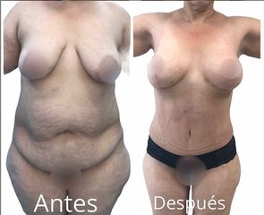 Lipoescultura - Dr. Hugo Javier Mejía Cuello