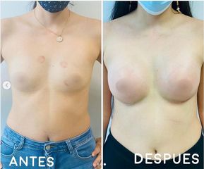 Mamoplastia de aumento - Dr. Hugo Javier Mejía Cuello