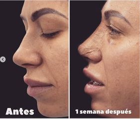 Rinoplastia - Dr. Hugo Javier Mejía Cuello