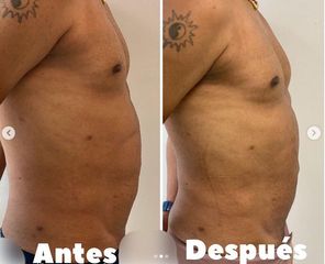 Liposucción - Dr. Hugo Javier Mejía Cuello