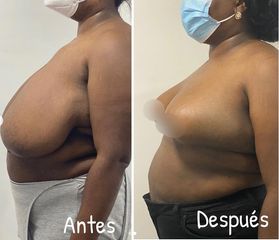 Mamoplastia de reducción - Dr. Hugo Javier Mejía Cuello
