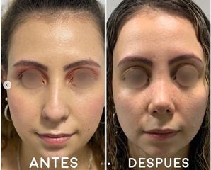 Rinoplastia - Dr. Hugo Javier Mejía Cuello