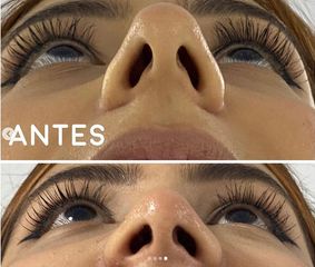 Rinoplastia - Dr. Hugo Javier Mejía Cuello