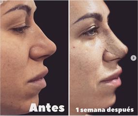 Rinoplastia - Dr. Hugo Javier Mejía Cuello