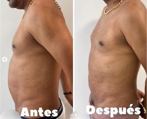 Liposucción - Dr. Hugo Javier Mejía Cuello