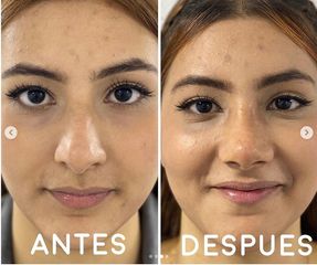 Rinoplastia - Dr. Hugo Javier Mejía Cuello