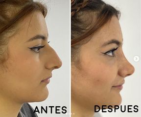 Rinoplastia - Dr. Hugo Javier Mejía Cuello