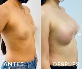 Mamoplastia de aumento - Dr. Hugo Javier Mejía Cuello