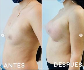 Mamoplastia de aumento - Dr. Hugo Javier Mejía Cuello