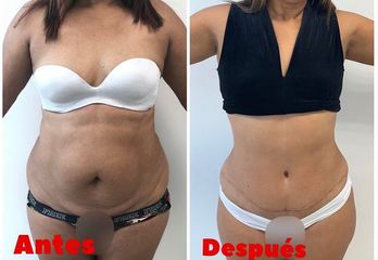 Abdominoplastia - Dr. Hugo Javier Mejía Cuello