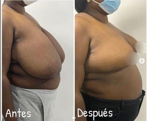 Mamoplastia de reducción - Dr. Hugo Javier Mejía Cuello