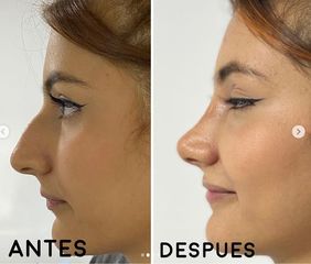 Rinoplastia - Dr. Hugo Javier Mejía Cuello