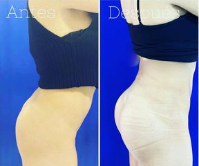 Gluteoplastia - Dr. Hugo Javier Mejía Cuello