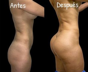 Gluteoplastia - Dr. Hugo Javier Mejía Cuello