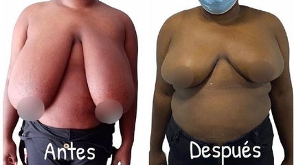 Mamoplastia de reducción - Dr. Hugo Javier Mejía Cuello