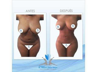 Lipoescultura - Dr. William Otero Olaya