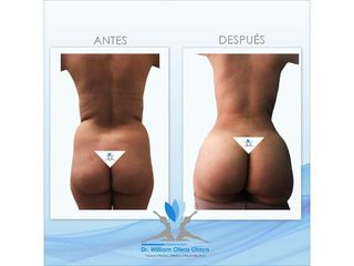 Gluteoplastia - Dr. William Otero Olaya